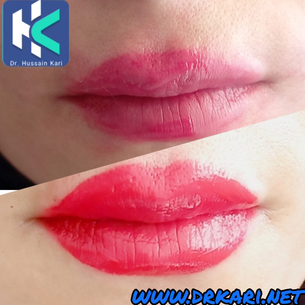 قبل و بعد تزریق ژل لب زیباجویان محترم